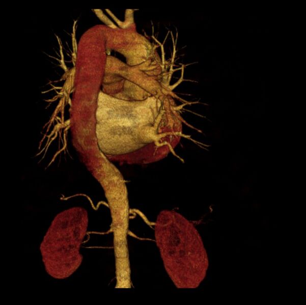 File:Aortic dissection with rupture into pericardium (Radiopaedia 12384-12647 D 18).jpg