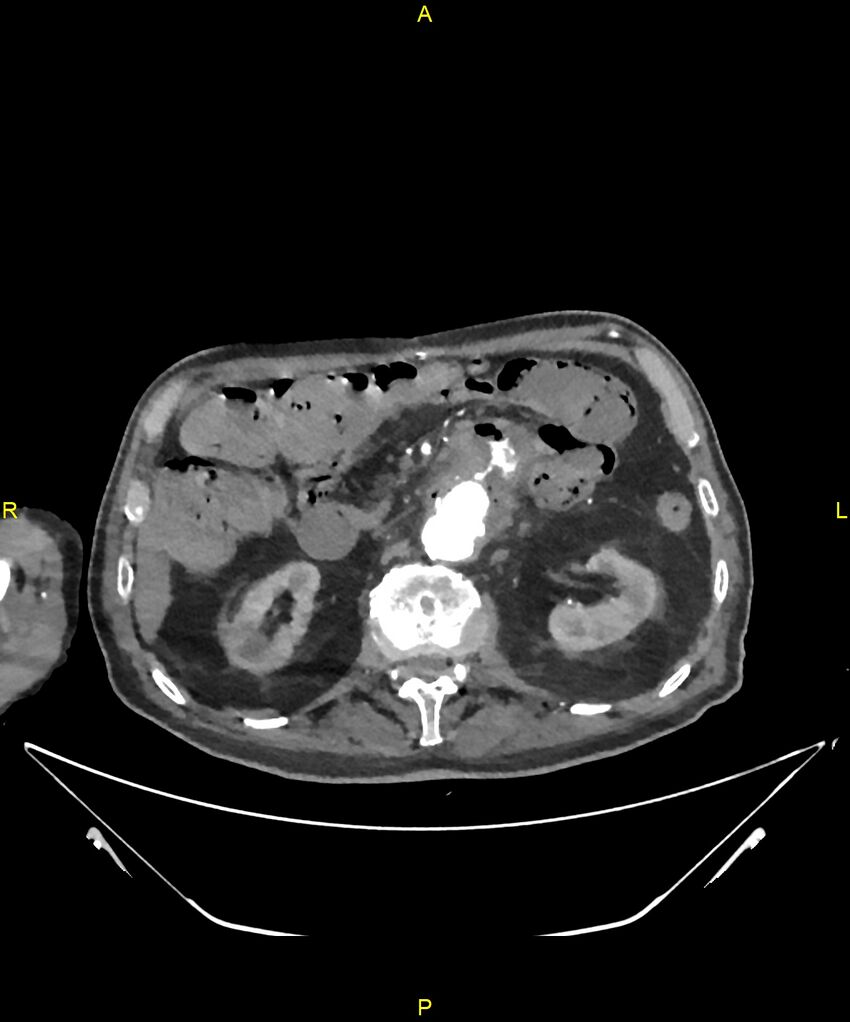 Aortoenteric fistula (Radiopaedia 84308-99603 B 127).jpg