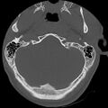 Apical pneumothorax on cervical spine CT (Radiopaedia 45343-49368 Axial bone window 2).jpg