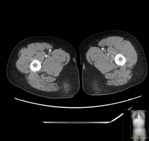 File:Appendicitis (CT angiogram) (Radiopaedia 154713-127660 Axial 140).jpg
