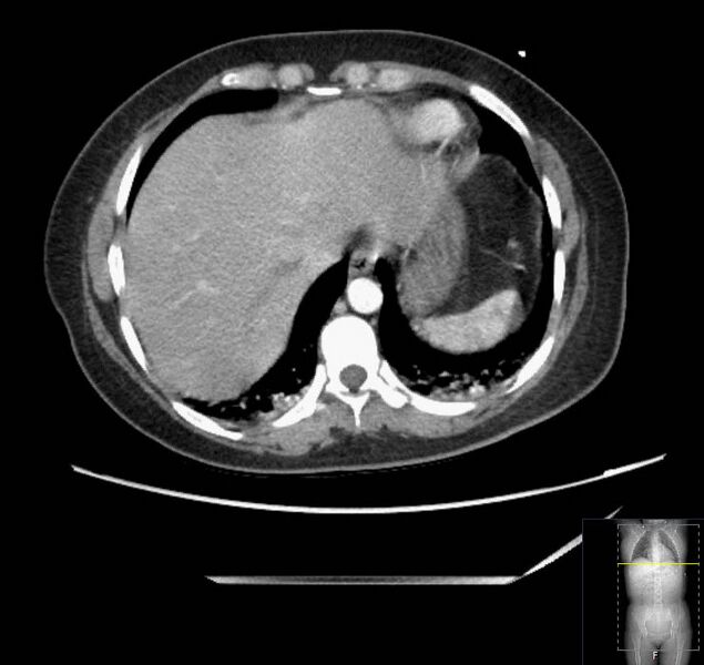 File:Appendicitis (CT angiogram) (Radiopaedia 154713-127660 Axial 172).jpg