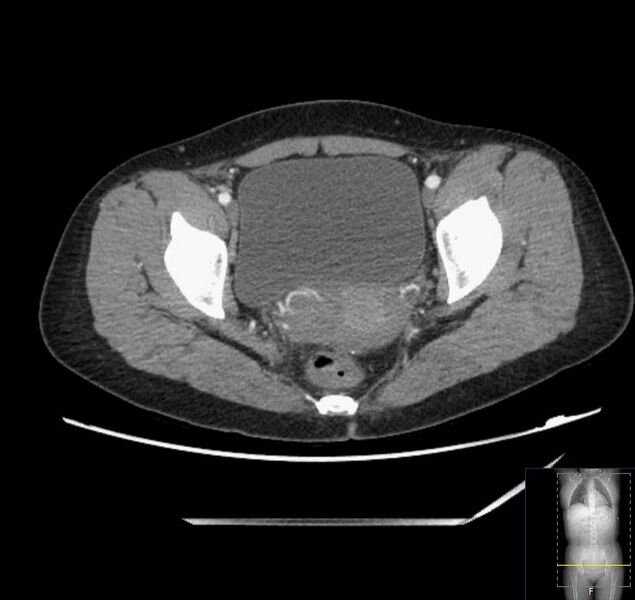 File:Appendicitis (CT angiogram) (Radiopaedia 154713-127660 Axial 50).jpg