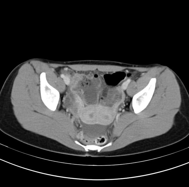 File:Appendicitis and incidental bicornuate uterus (Radiopaedia 22833-22853 B 40).jpg