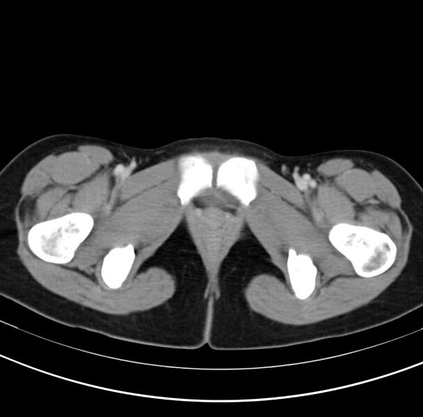 File:Appendicitis and incidental bicornuate uterus (Radiopaedia 22833-22853 B 48).jpg