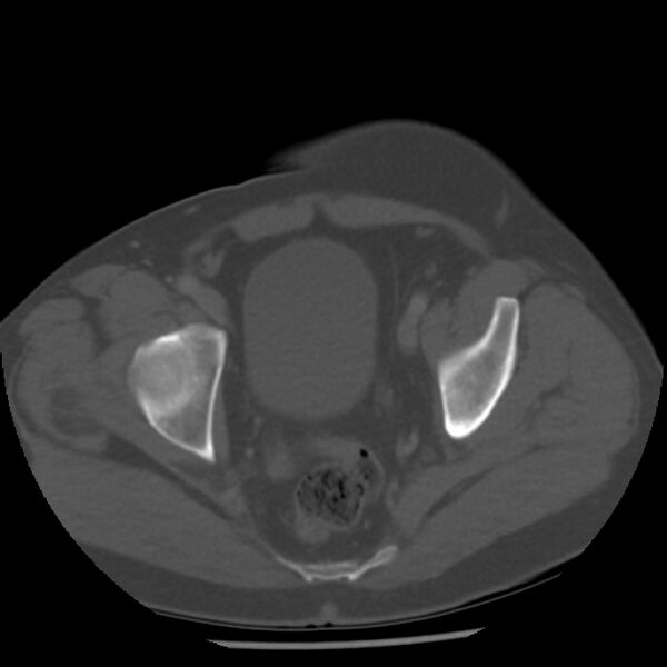 File:Appendicitis with perforation (Radiopaedia 35790-37342 Axial bone window 47).jpg