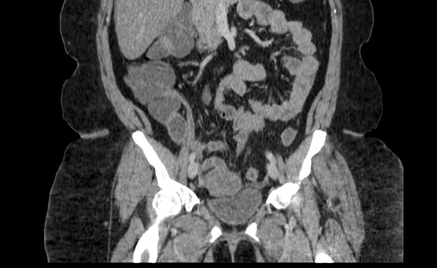 Appendix mucocele (Radiopaedia 41222-44033 B 35).jpg