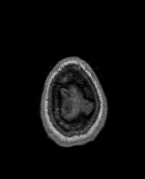 File:Arachnoid cyst- extremely large (Radiopaedia 68741-78451 Axial T1 75).jpg