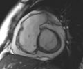 Arrhythmogenic right ventricular cardiomyopathy (Radiopaedia 69431-79307 Short axis cine 163).jpg