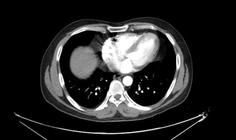 File:Arterial occlusive mesenteric ischemia (Radiopaedia 84641-100060 A 12).jpg