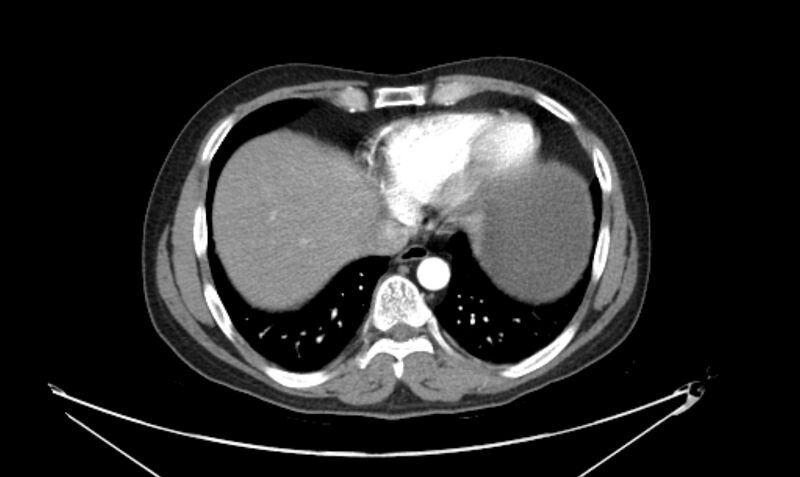 File:Arterial occlusive mesenteric ischemia (Radiopaedia 84641-100060 A 16).jpg