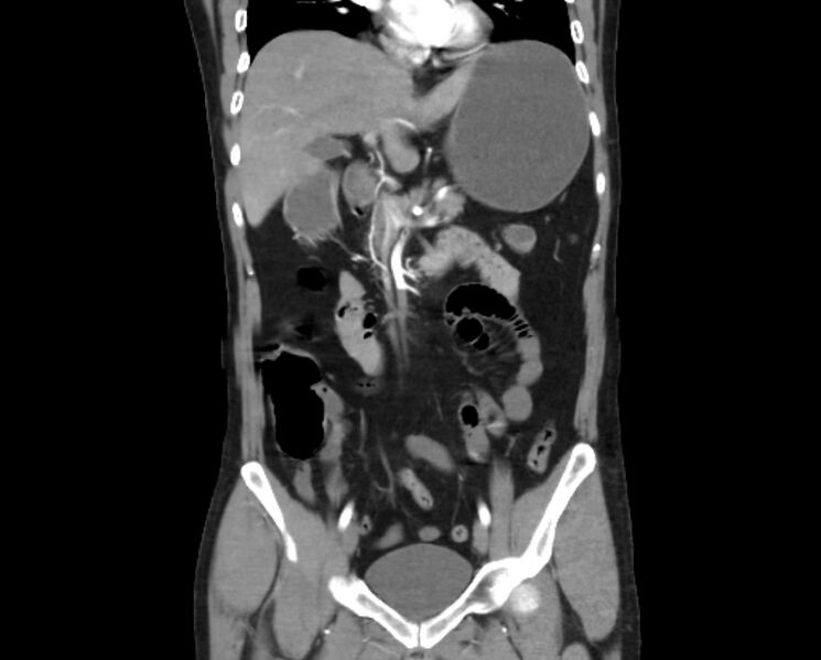 File:Arterial occlusive mesenteric ischemia (Radiopaedia 84641-100060 B 25).jpg