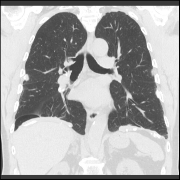 File:Asbestos-related pleural plaques (Radiopaedia 39069-41255 Coronal lung window 39).jpg