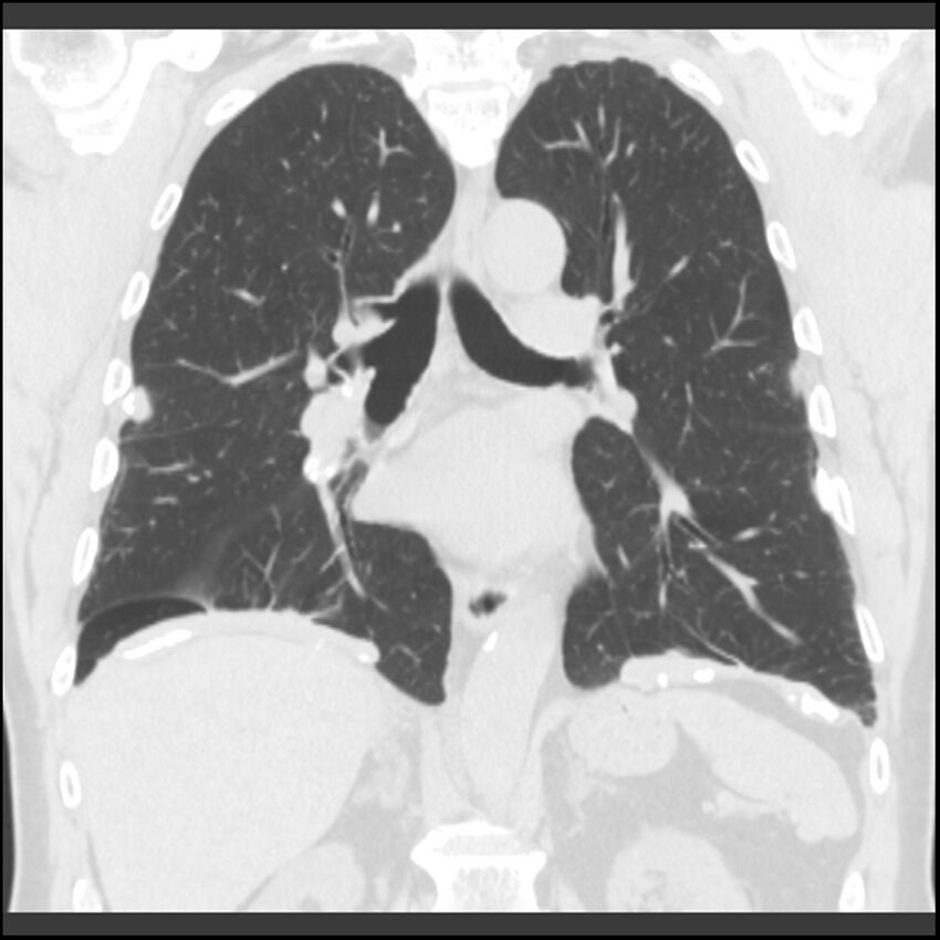 Asbestos-related pleural plaques (Radiopaedia 39069-41255 Coronal lung window 39).jpg