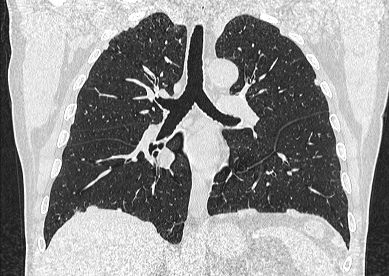 File:Asbestos pleural placques (Radiopaedia 57905-64872 Coronal lung window 159).jpg