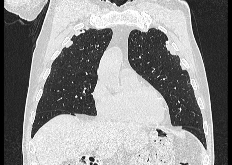 File:Asbestos pleural placques (Radiopaedia 57905-64872 Coronal lung window 78).jpg