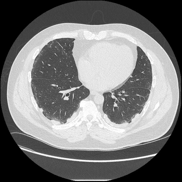 File:Asbestosis (Radiopaedia 45002-48961 Axial lung window 32).jpg