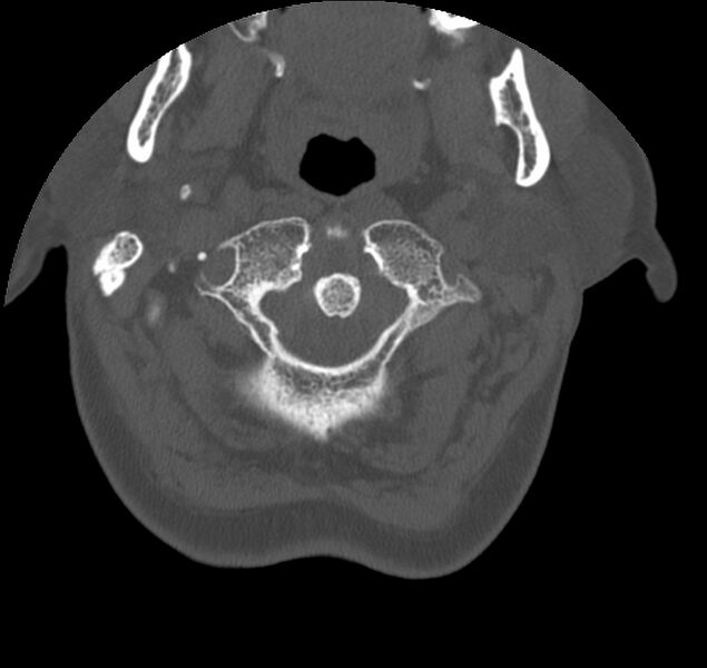 File:Atlanto-occipital assimilation with basilar invagination (Radiopaedia 70122-80188 Axial bone window 21).jpg
