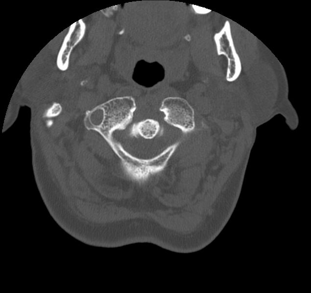 File:Atlanto-occipital assimilation with basilar invagination (Radiopaedia 70122-80188 Axial bone window 23).jpg