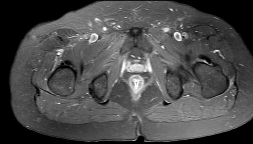 Atypical lipomatous tumor - thigh (Radiopaedia 68975-78734 Axial PD fat sat 87).jpg