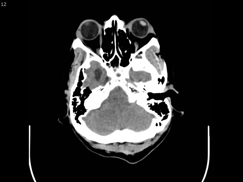 File:Atypical meningioma - intraosseous (Radiopaedia 64915-73867 A 12).jpg