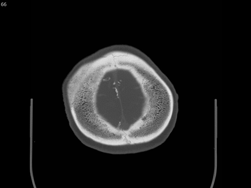 Atypical meningioma - intraosseous (Radiopaedia 64915-73867 Axial C+ bone window 66).jpg