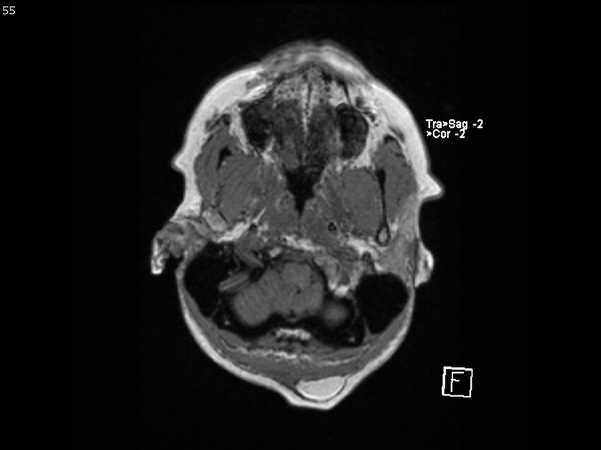 Atypical meningioma - intraosseous (Radiopaedia 64915-74572 Axial T1 55).jpg