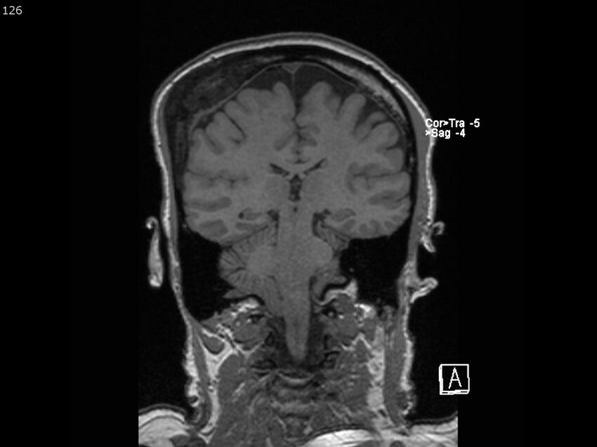 Atypical meningioma - intraosseous (Radiopaedia 64915-74572 Coronal T1 126).jpg