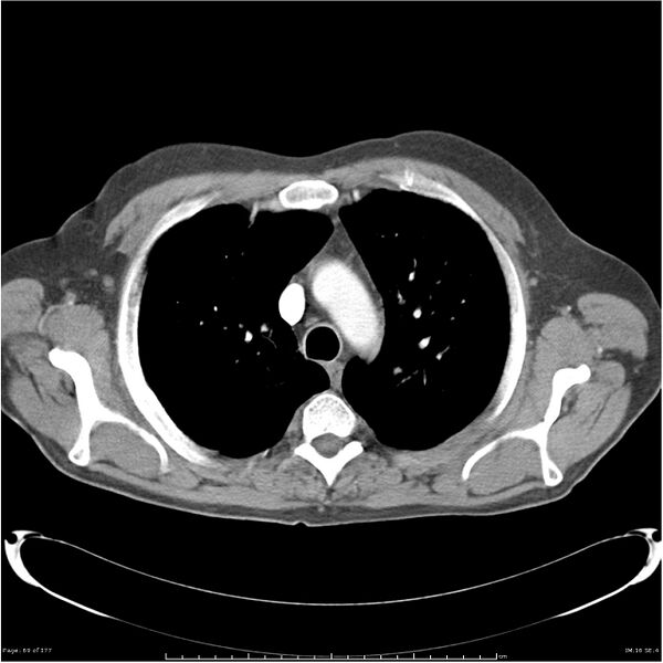 File:Atypical pneumonia - Q fever (Radiopaedia 21993-21989 C+ arterial phase 11).jpg