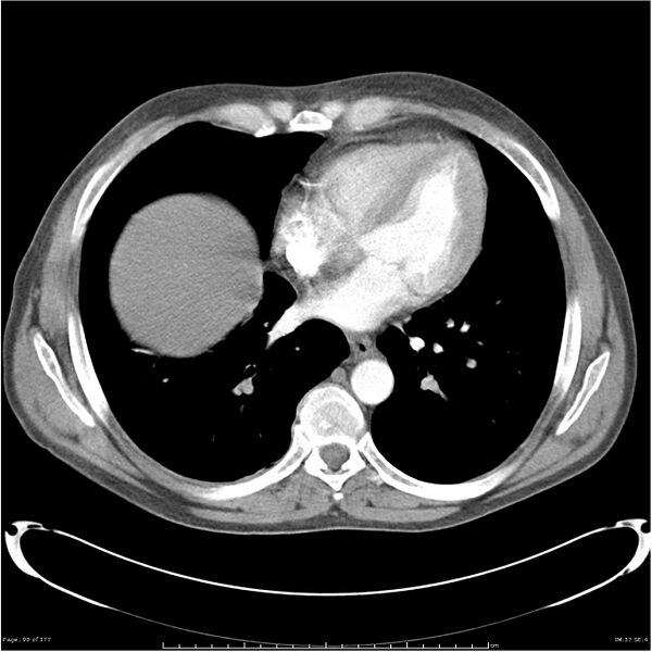 File:Atypical pneumonia - Q fever (Radiopaedia 21993-21989 C+ arterial phase 32).jpg
