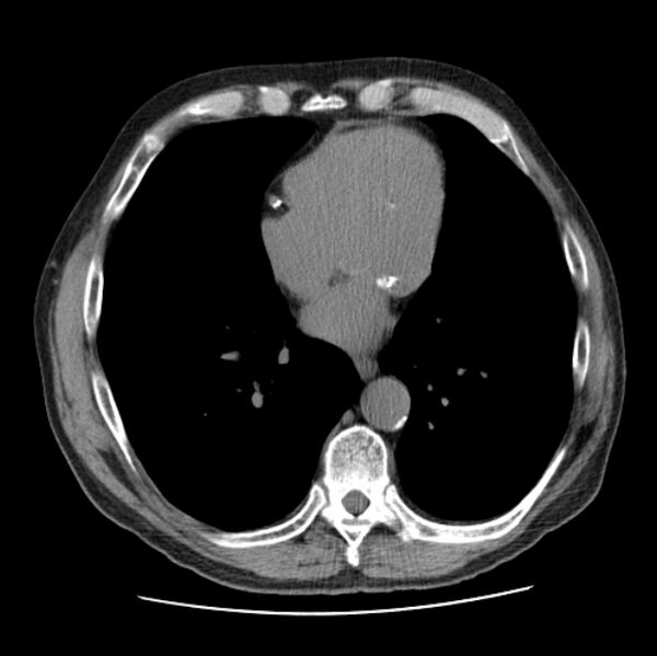 File:Autosomal dominant polycystic kidney disease (Radiopaedia 27851-28094 Axial non-contrast 37).jpg
