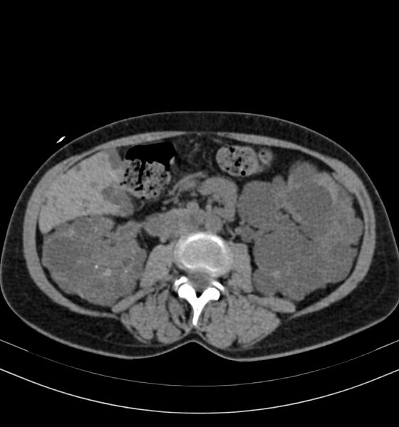 File:Autosomal dominant polycystic kidney disease (Radiopaedia 41918-44922 Axial non-contrast 16).jpg