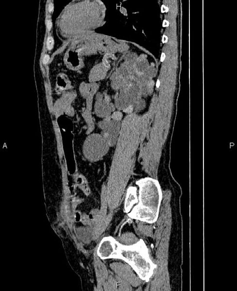 File:Autosomal dominant polycystic kidney disease (Radiopaedia 87830-104287 C 62).jpg