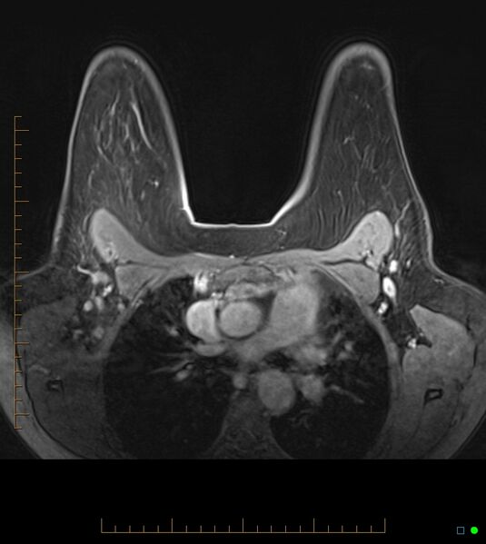 File:Axillary lymphadenopathy on breast MRI- yellow fever vaccination induced (Radiopaedia 19454-19483 Axial T1 C+ fat sat 30).jpg