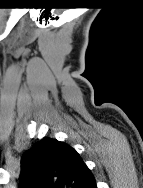 File:Axis peg fracture (type 3) and atlas lateral mass (type 4) fracture (Radiopaedia 37474-39324 D 68).png