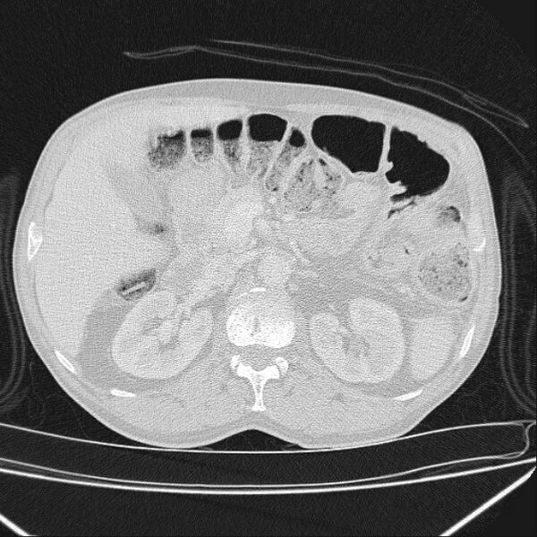 File:Azygos lobe (Radiopaedia 38259-40275 Axial lung window 94).jpg