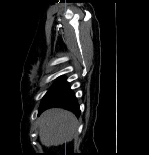 File:Azygos vein aneurysm (Radiopaedia 77824-90130 D 32).JPG