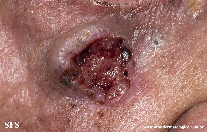 Basal Cell Carcinoma (Dermatology Atlas 261).jpg
