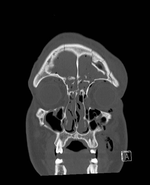 File:Base of skull fracture with bilateral Le Fort fractures (Radiopaedia 47094-51638 Coronal bone window 82).jpg