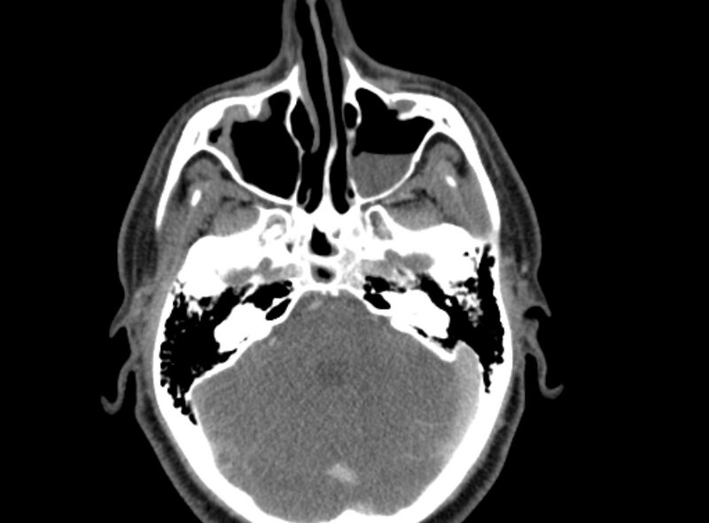 File:Benign mixed salivary tumor of the parotid gland (Radiopaedia 35261-36792 A 7).jpg