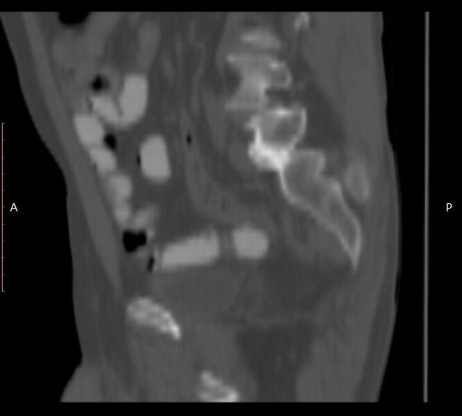File:Bertolotti syndrome (Radiopaedia 58974-66235 Sagittal bone window 41).jpg