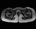 Bicornuate bicollis uterus (Radiopaedia 61626-69616 Axial T2 35).jpg