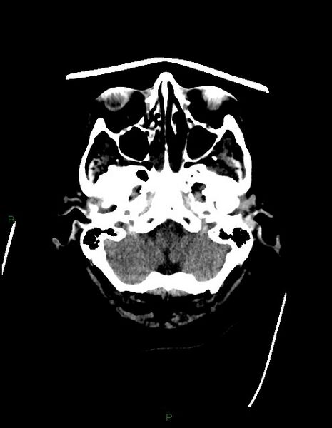 File:Bilateral acute middle cerebral artery territory infarcts (Radiopaedia 77319-89401 Axial non-contrast 11).jpg