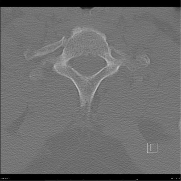 File:Bilateral cervical ribs (Radiopaedia 25868-26017 Axial bone window 43).jpg