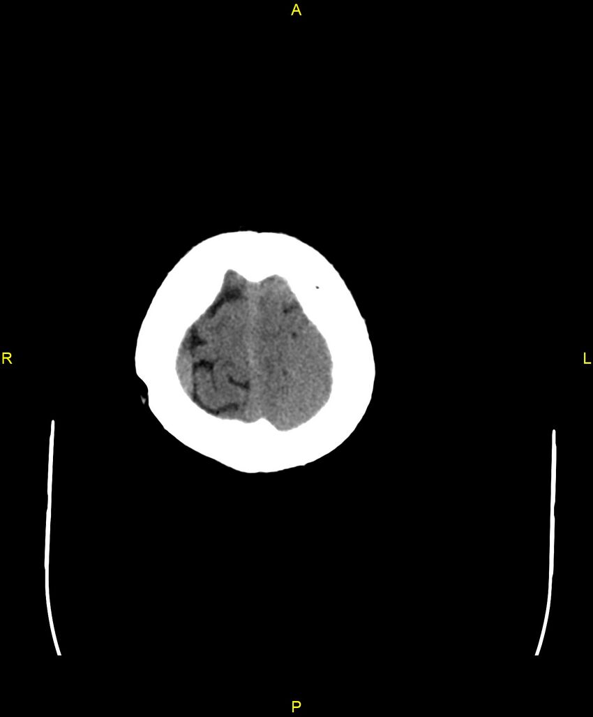 Bilateral isodense subdural hematomas (Radiopaedia 88621-105325 Axial non-contrast 102).jpg