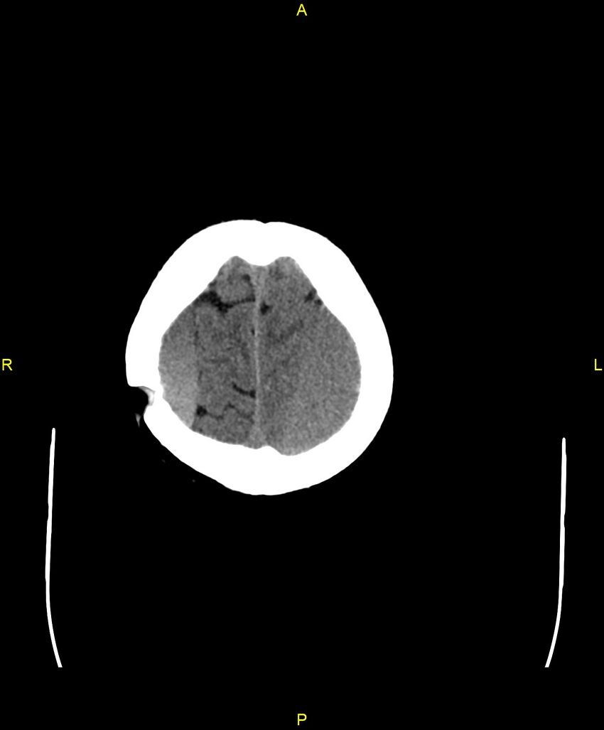 Bilateral isodense subdural hematomas (Radiopaedia 88621-105325 Axial non-contrast 98).jpg