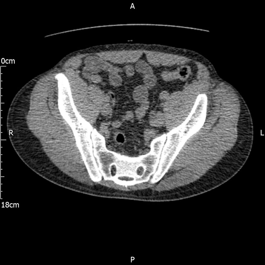 Bilateral medullary nephrocalcinosis with ureteric calculi (Radiopaedia 71269-81569 Axial non-contrast 105).jpg