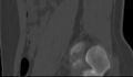 Bilateral pars defect (Radiopaedia 26691-26846 Sagittal bone window 55).jpg