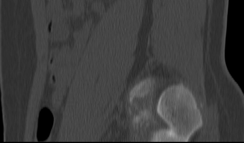 Bilateral pars defect (Radiopaedia 26691-26846 Sagittal bone window 55).jpg