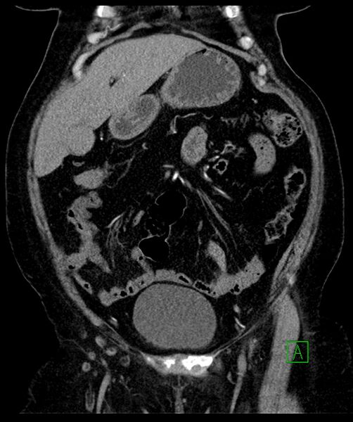 File:Bilateral sporadic synchronous clear cell renal cell carcinoma (Radiopaedia 85035-100575 D 37).jpg