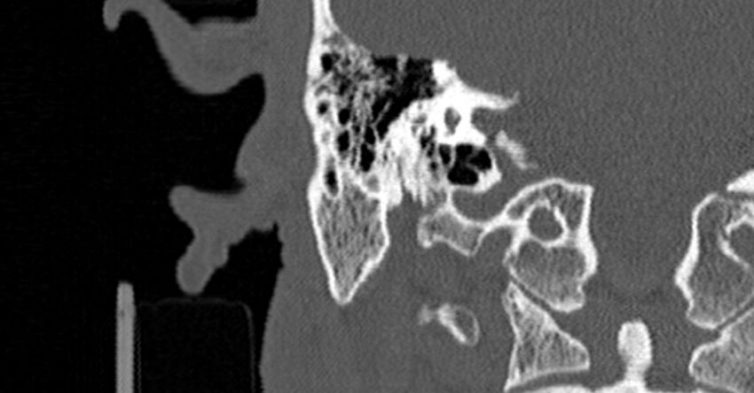 Bilateral temporal bone fractures (Radiopaedia 29482-29970 Coronal non-contrast 124).jpg